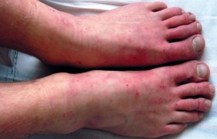Як лікувати дерматит на ногах