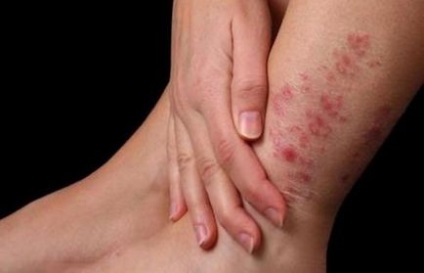 Як лікувати дерматит на ногах
