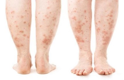 Hogyan kell kezelni dermatitis a lábakon