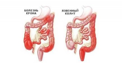 Cum să opriți diareea, remedii folclorice pentru diaree - informații despre sănătate