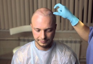 Як проводиться пересадка волосся безшовним методом особливості процедури, ціна