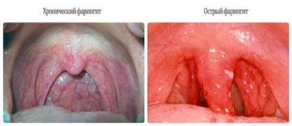 Cum de a vindeca faringita acută la copii, în gât