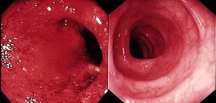 Cal și mucus sunt unul din primele simptome ale colitei ulcerative nespecifice