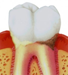 Caria rădăcinii dintelui