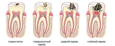 Carii dentare și varietățile sale