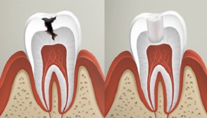 A fogszuvasodás és annak változatai (caries) A fogszuvasodás és variánsai