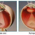 Cataracta cauze, simptome, tratament și prevenirea prin remedii populare, la vârstnici