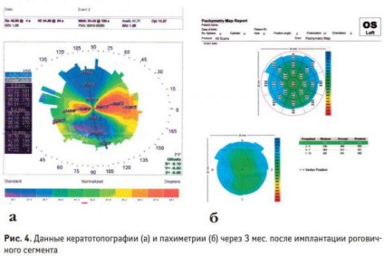 Keratotopografia ochiului sau topografia corneei așa cum a fost efectuată, interpretarea indicatorilor