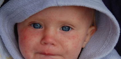 Кір симптоми у дітей як розпізнати хворобу на ранній стадії, фото