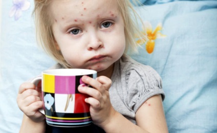 Simptomele rujeolei la copii cum să recunoască boala într-un stadiu incipient, fotografie