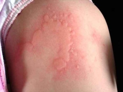 Urticaria klinikai tünetek, különösen a gyermekeit, és különösen a terápiás elvek