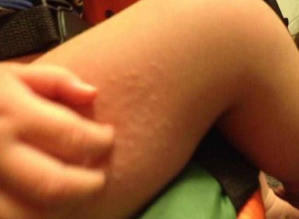 Urticaria klinikai tünetek, különösen a gyermekeit, és különösen a terápiás elvek