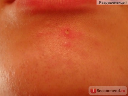 Крем від прищів isme acne spots cream з маслом чайного дерева і алое вера - «прищ go home!