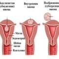 Babérlevél a népi gyógyászatban, a használat és a hasznos babérlevelet