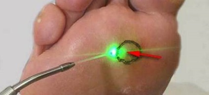 Îndepărtarea cu laser a corneelor ​​este cea mai bună metodă - cosmetologia hardware