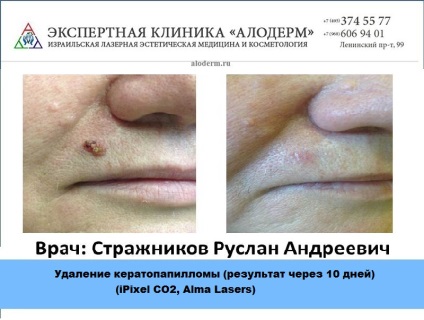 Tratamentul papiloamelor cu laser în Moscova, aloderm