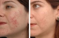Tratamentul pigmentării pielii cu laser