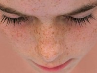 Tratamentul pigmentării pielii cu laser