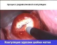 Tratamentul cu eroziune cervicală subrogronă
