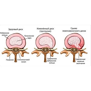 Hernia intervertebrală este o problemă pe care 80% din populație o are