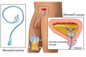 Cateterul urinar pentru femei și bărbați îngrijește, cum să pună, specii - să trăiască sănătoși