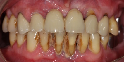 Program de restaurare dentară pentru mesaje subliminale