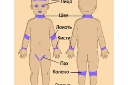 Unguente non-hormonale din dermatita