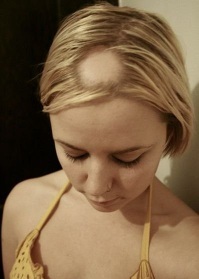 Baldness în cauzele și tratamentul femeilor, foto