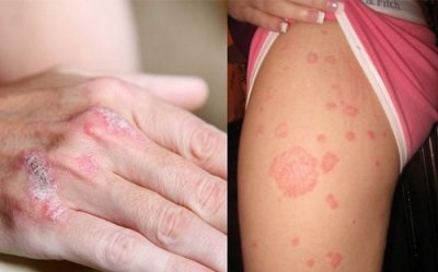 Exacerbarea psoriazisului ce să facă, cum să tratezi, dieta recomandată și prevenirea bolilor