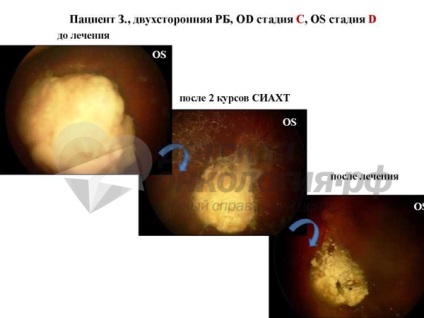 Офтальмоонкологія ванні дог