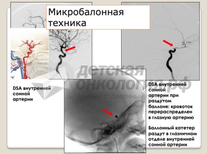 Офтальмоонкологія ванні дог