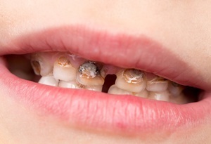 Restricțiile pentru implantarea dentară sunt principalele contraindicații pentru procedură, recomandările medicilor dentiști