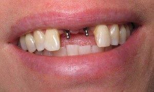 Обмеження для імплантації зубів основні протипоказання для процедури, рекомендації стоматологів