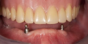 Korlátozások a fogászati ​​implantátumok nagy ellenjavallata az eljárást, fogászati ​​ajánlások