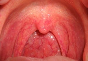 Faringita acută la copii și simptome și tratament (foto)