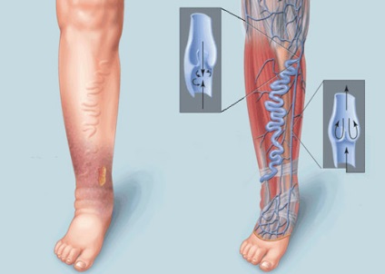 Umflarea picioarelor cu tratament cu insuficiență venoasă vasculară, tratamentul venelor varicoase