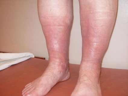 Umflarea picioarelor cu tratament cu insuficiență venoasă vasculară, tratamentul venelor varicoase
