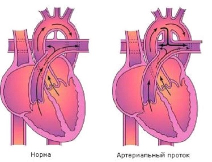 Nyitott ductus arteriosus