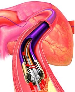 Nyitott ductus arteriosus