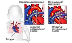 Nyitott ductus arteriosus