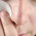 Terapia cu ozon pentru acnee, acnee - descrierea și eficacitatea procedurii