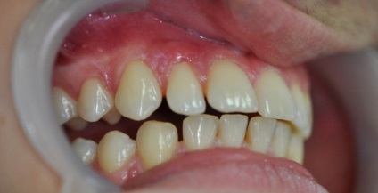 Parodonția - tratamentul parodontitei și a bolii gingiilor