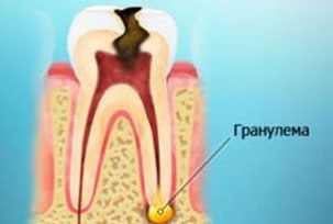 Periodontita Metode fiabile de tratament, cum să vă păstrați dintele