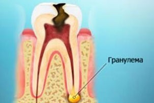 Періодонтит надійні методи лікування, як зберегти зуб