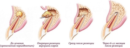 Periodontita Metode fiabile de tratament, cum să vă păstrați dintele