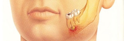 Періодонтит надійні методи лікування, як зберегти зуб