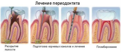 Periodontita Metode fiabile de tratament, cum să vă păstrați dintele