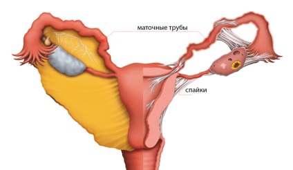 Pulverizarea tuburilor uterine