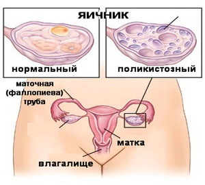 Первинний і вторинний полікістоз яєчників причини захворювання, симптоми і лікування