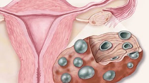 Bolile ovariene polichistice primare și secundare cauzează simptome și tratament